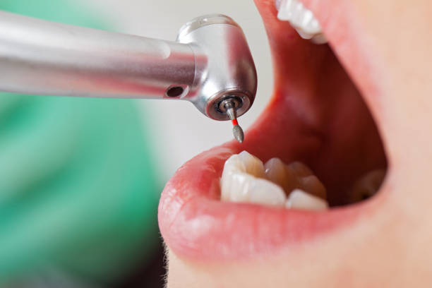 Best Emergency Root Canal Treatment in Allendale, MI